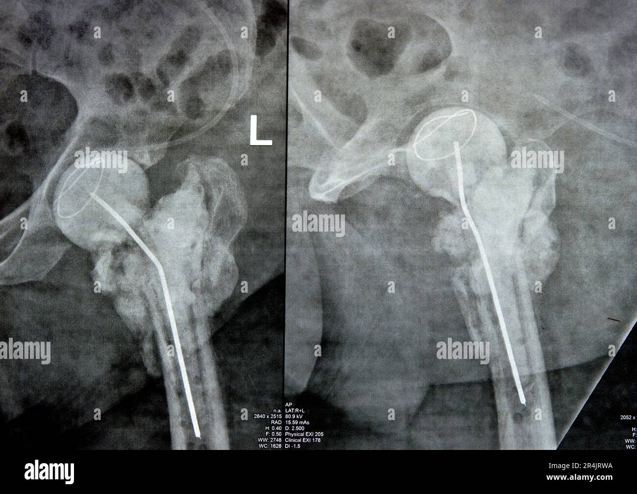 Plain X ray hip joint show left trans cervical fracture of the head of femur with temporary antibiotic loader spacer antibiotic-loaded bone cement aft Stock Photo