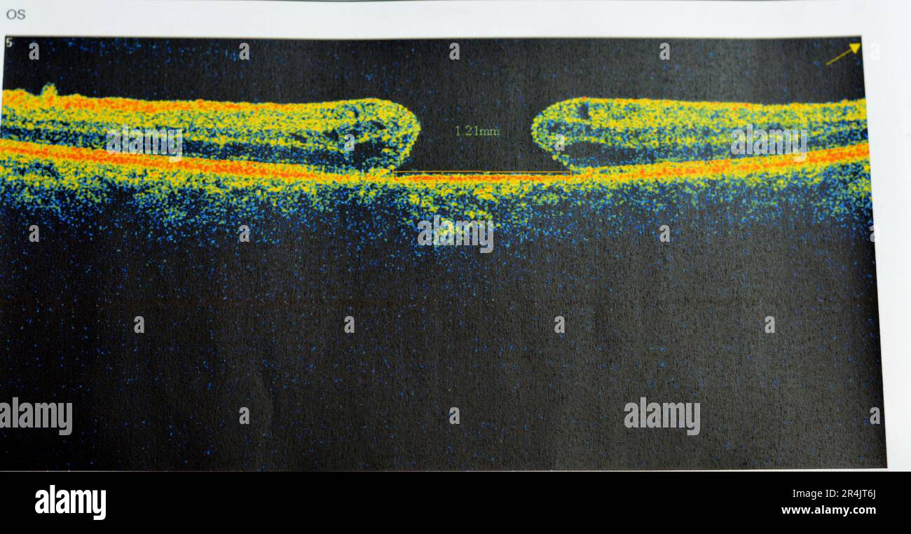 OCT of the eye reveals faint epimacular membrane and full thickness ...