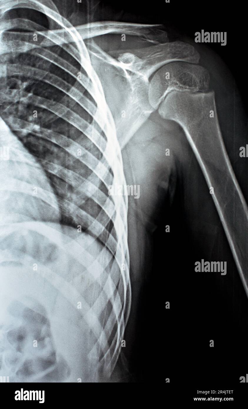 X Ray Shoulder Lateral View