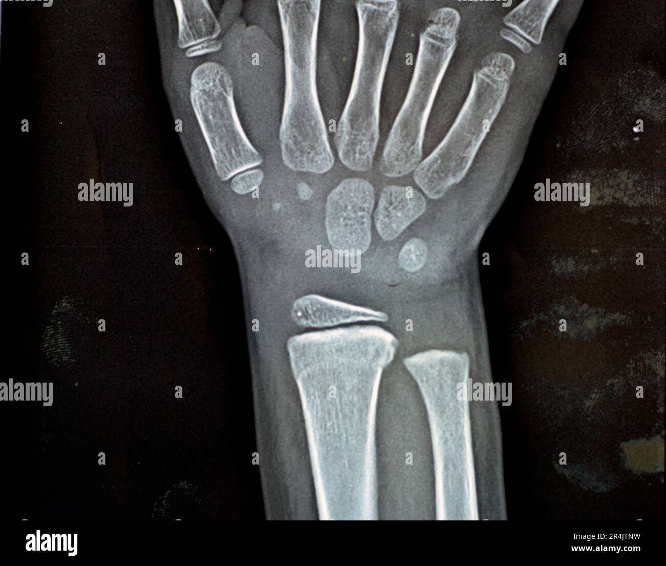 Normal Pediatric Wrist X Ray Pediatric Normal Imaging Examples VQTZLH