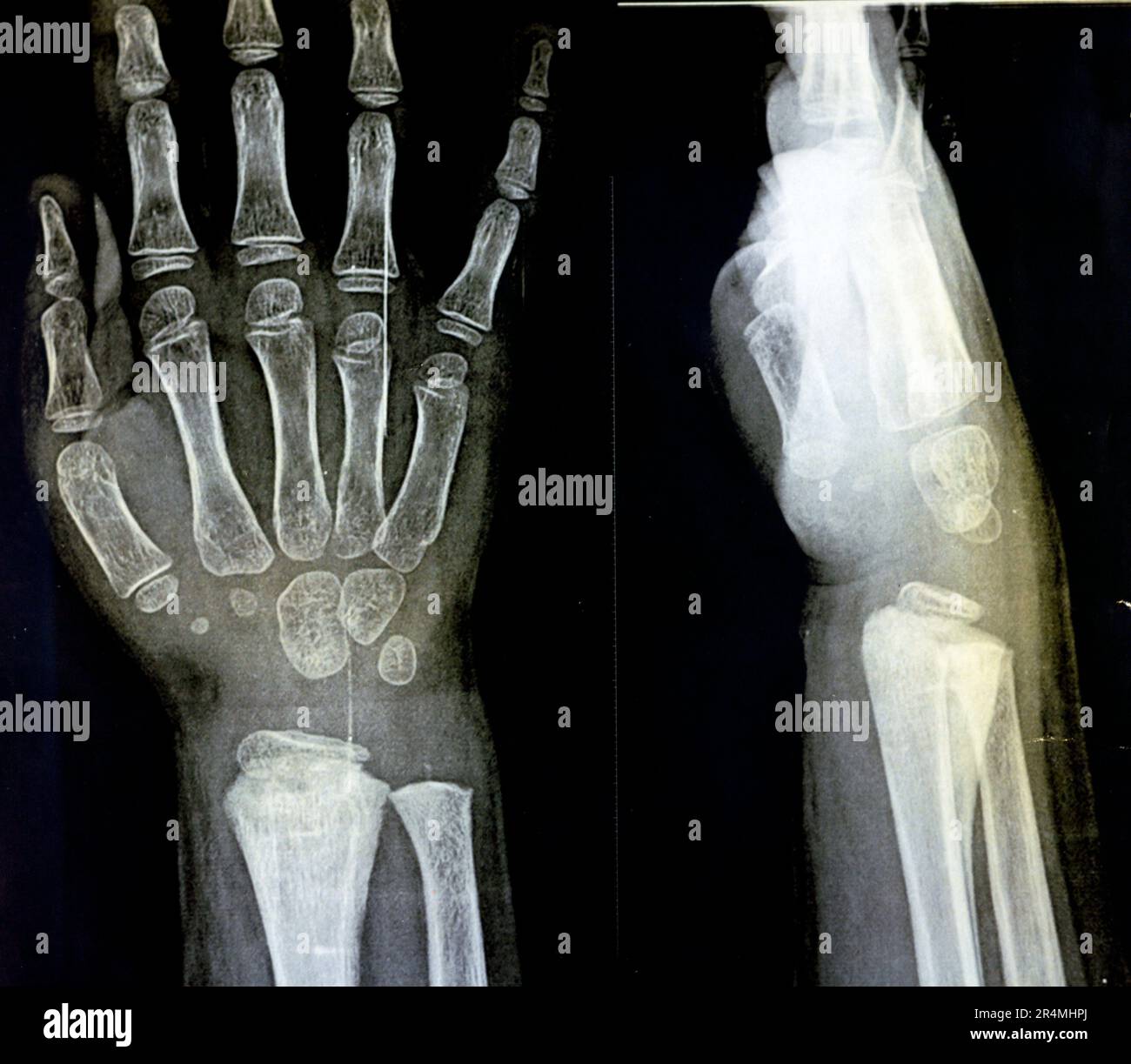A PXR plain x ray of right wrist joint of skeletally immature female child patient shows neglected physeal injury of right distal radius bone, Injury Stock Photo