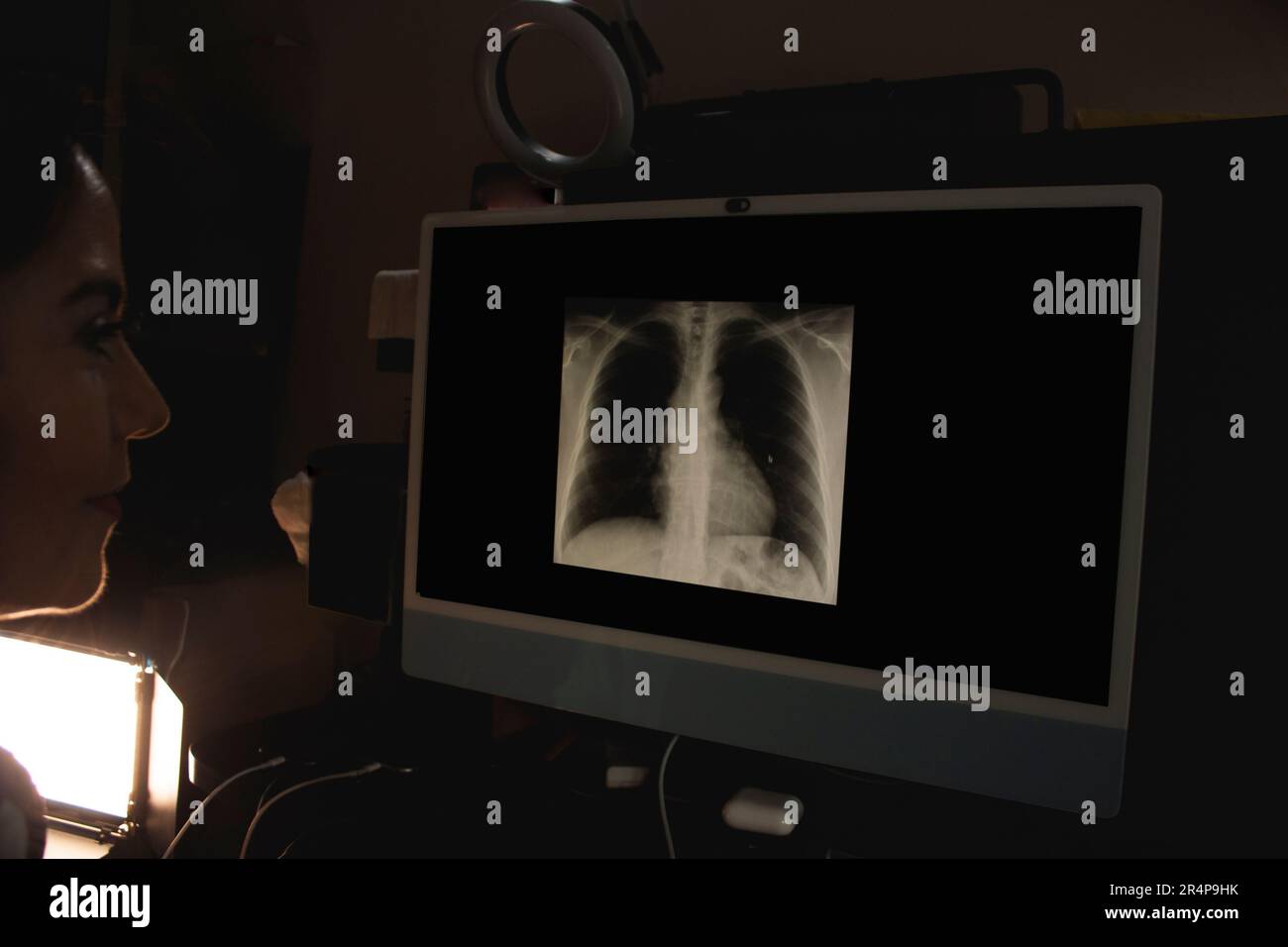 Pulmonologist woman checks on the computer Xray of patient post