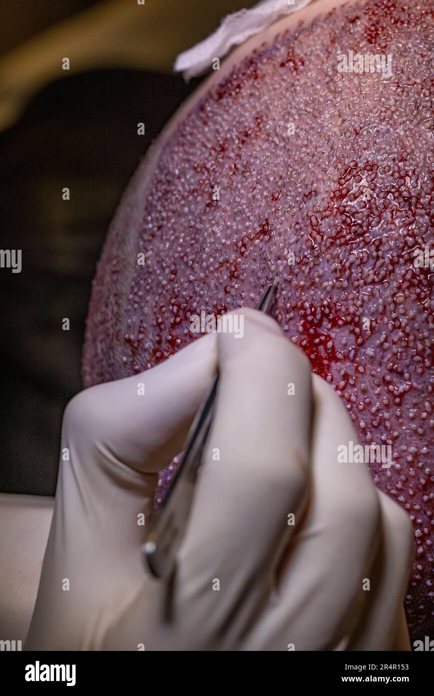 Hair transplant dhi and fue system. Hair Transplant patient after the operation. Surgeons in the operating room carry out hair transplant surgery. Stock Photo