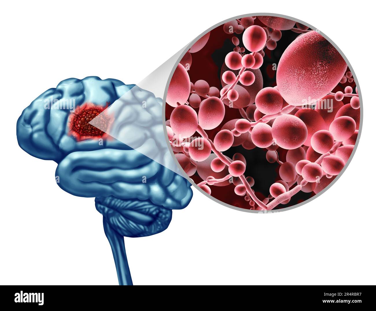 Deadly Brain Fungal Infection concept as a microbe threat and mucormycosis life threatening fungus as Candida auris fungi spreading in the nervous sys Stock Photo