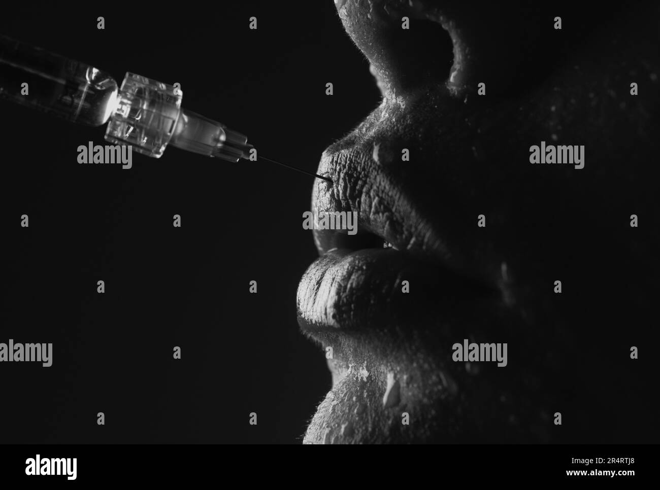 Lips Cosmetology. Hyaluronic acid injection. Procedure of lip