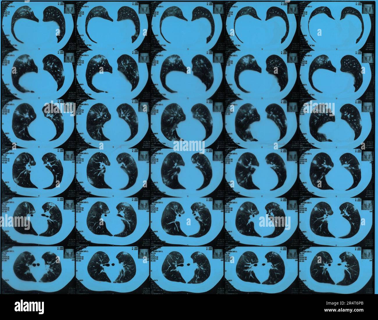 MRI lung scan of male patient after COVID infection Stock Photo