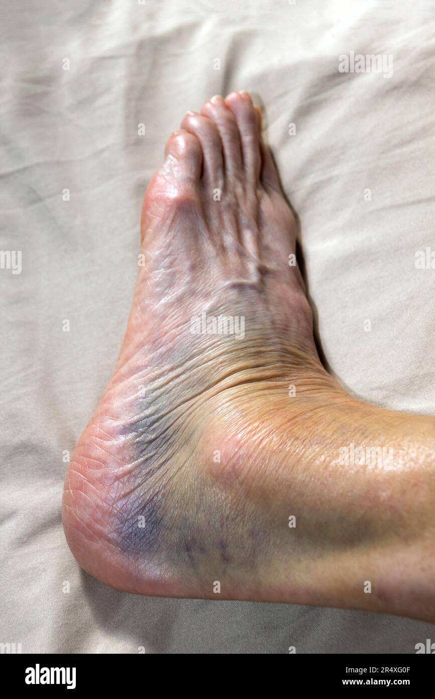 Closeup of a woman's sprained ankle that's highly discolored. Model