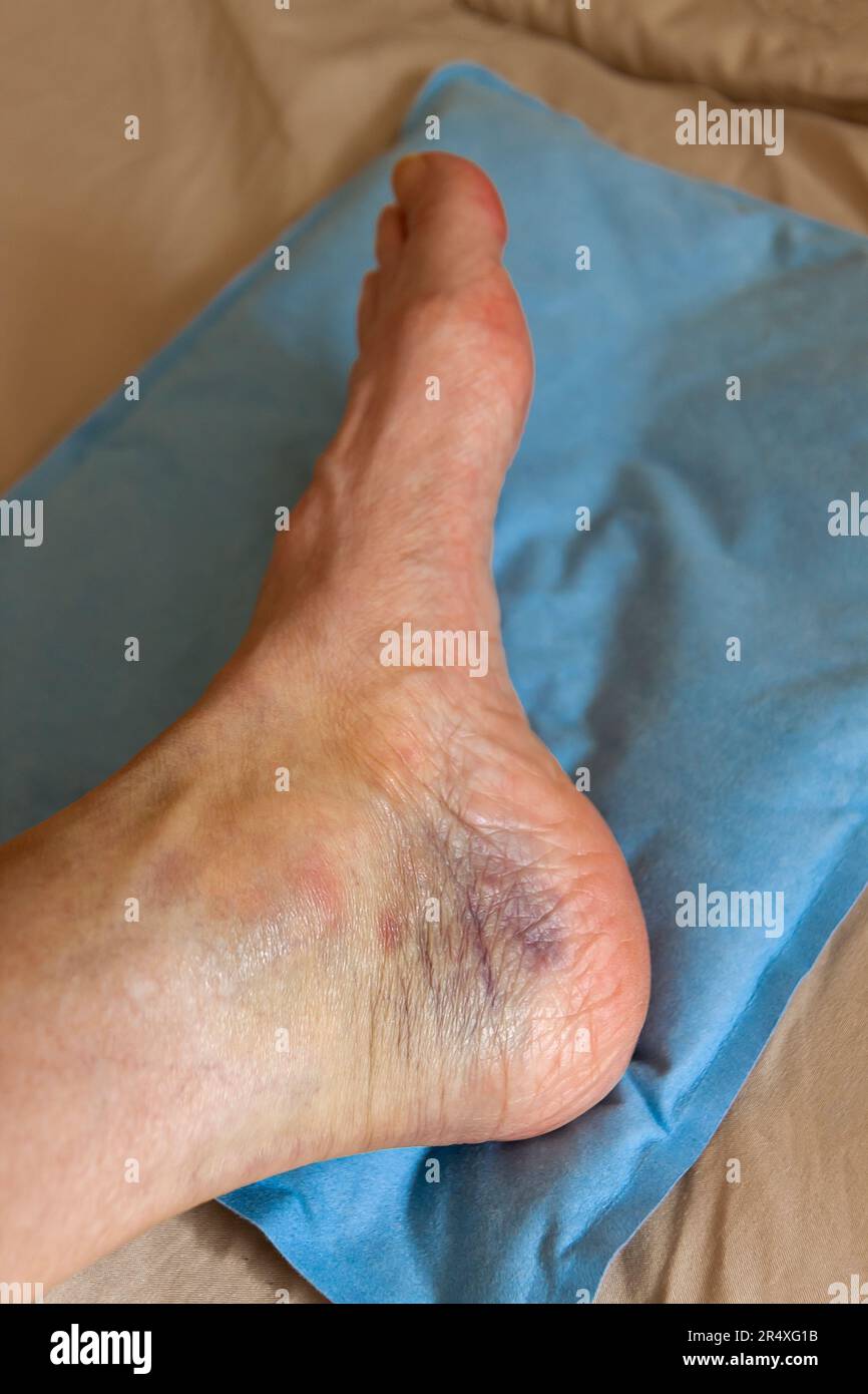 Closeup of a woman's sprained ankle that's highly discolored. Model Released Stock Photo Alamy