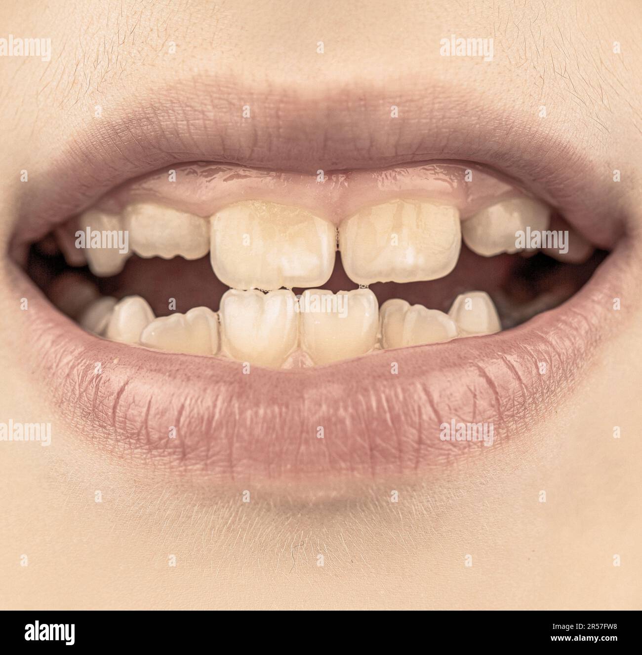 Bad teeth child. Portrait boy with bad teeth. Close up of unhealthy