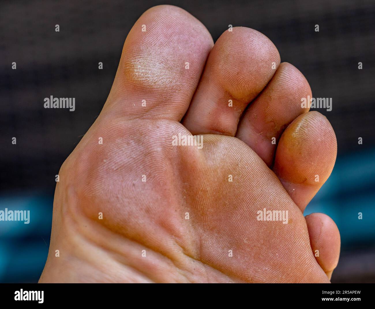 Calluses with athlete's foot and warts on the foot Stock Photo Alamy