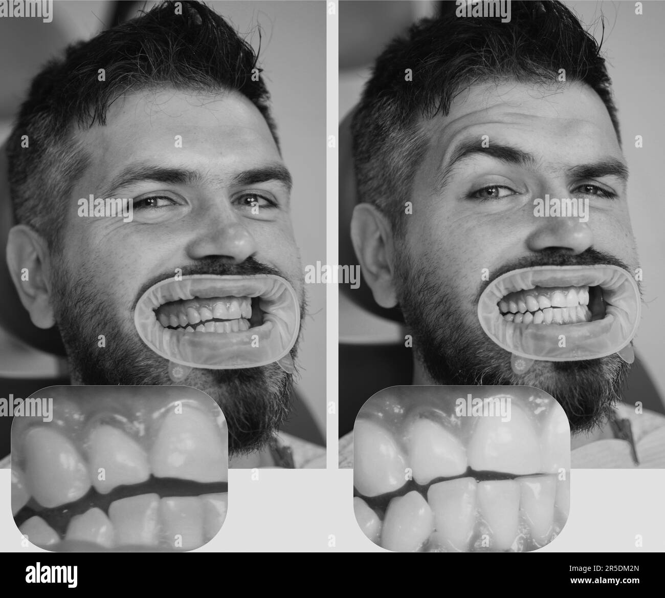 Whitening after and before. Man in dental chair. Dentist preparing for dental whitening. Health medicine people dentistry doctor curing. Result of tee Stock Photo