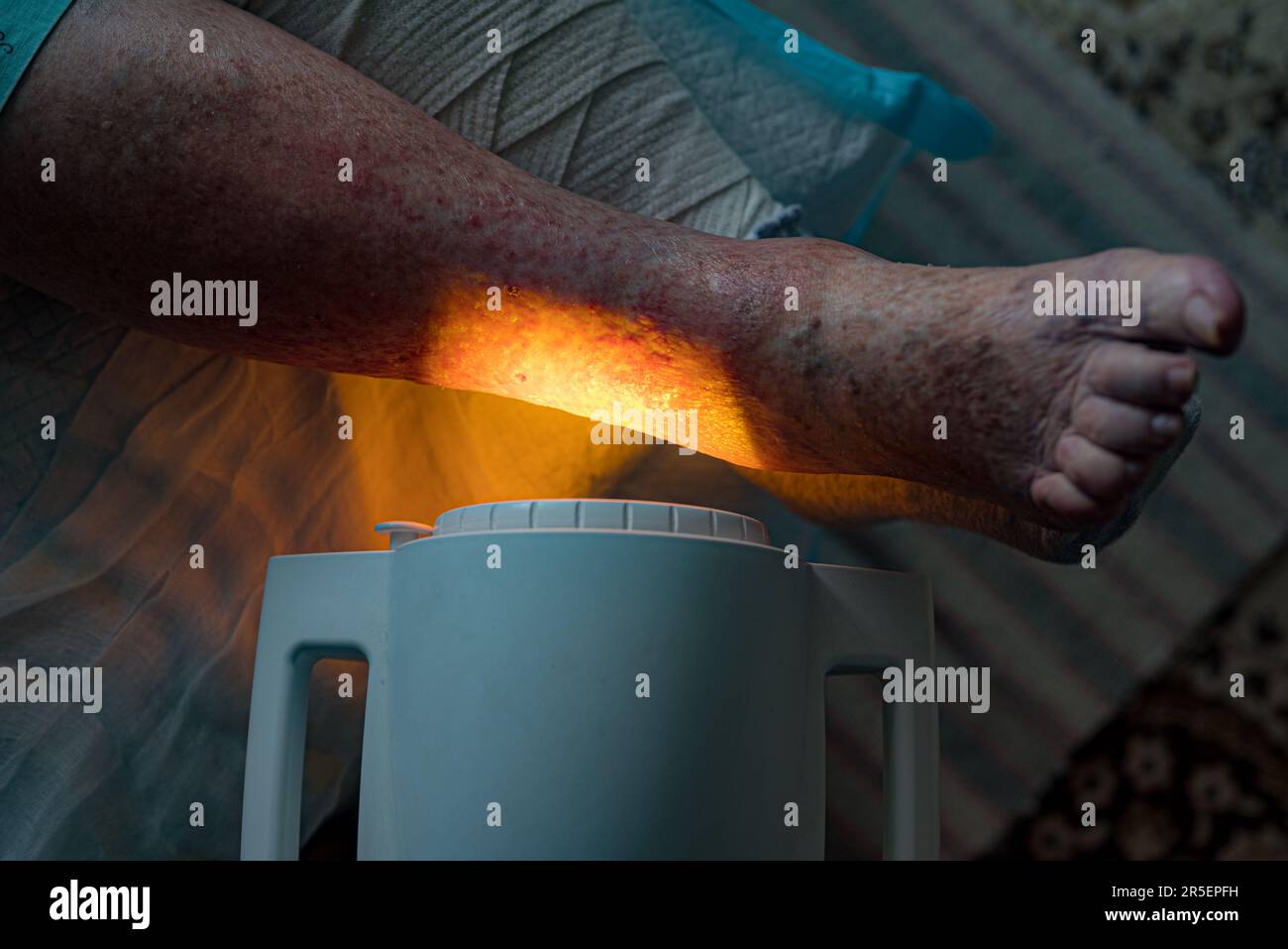 Light therapy given on ulcer (ulcus cruris Stock Photo Alamy