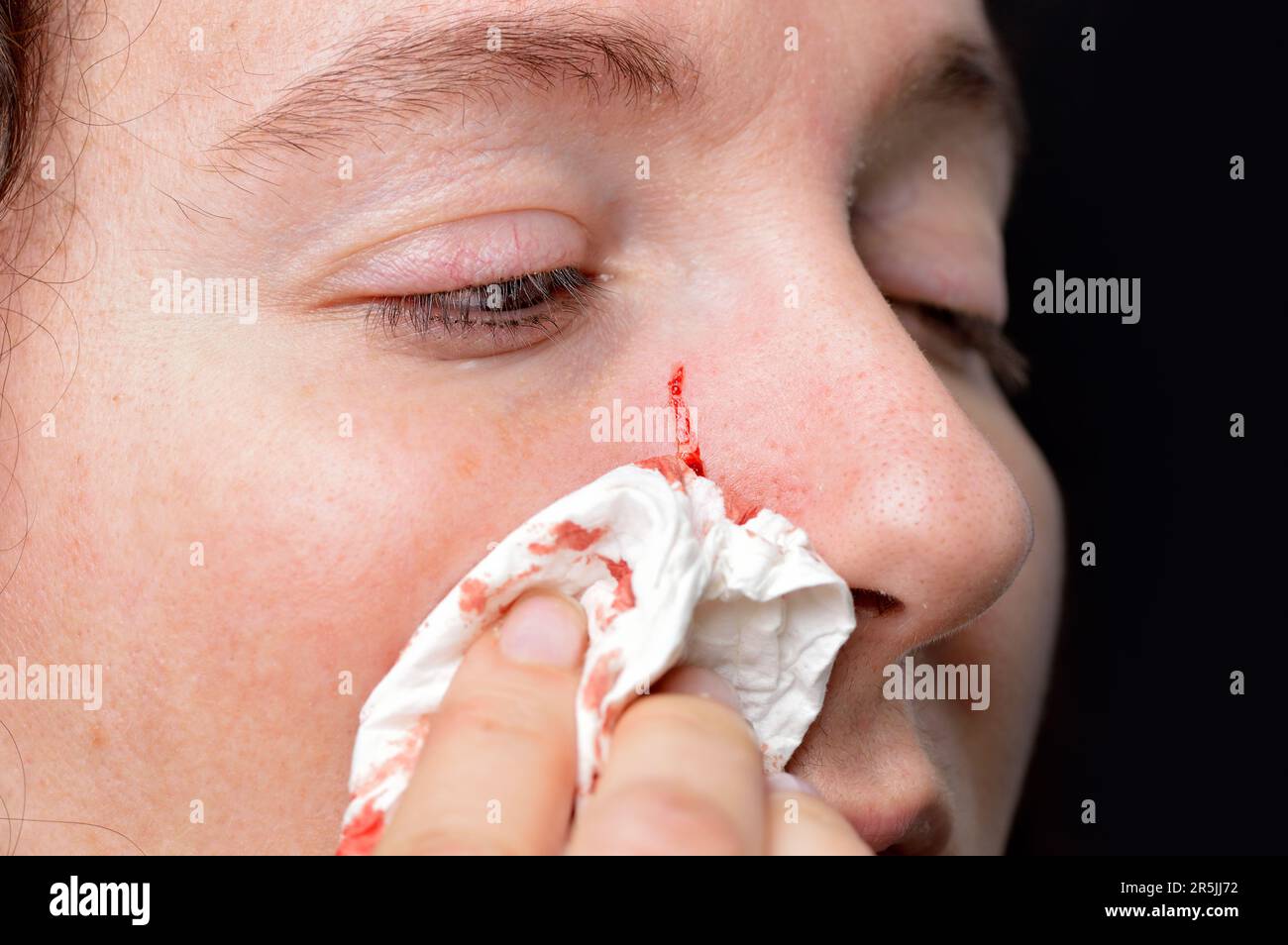 a woman who has been attacked by the nail an animal with an erida in the face Stock Photo