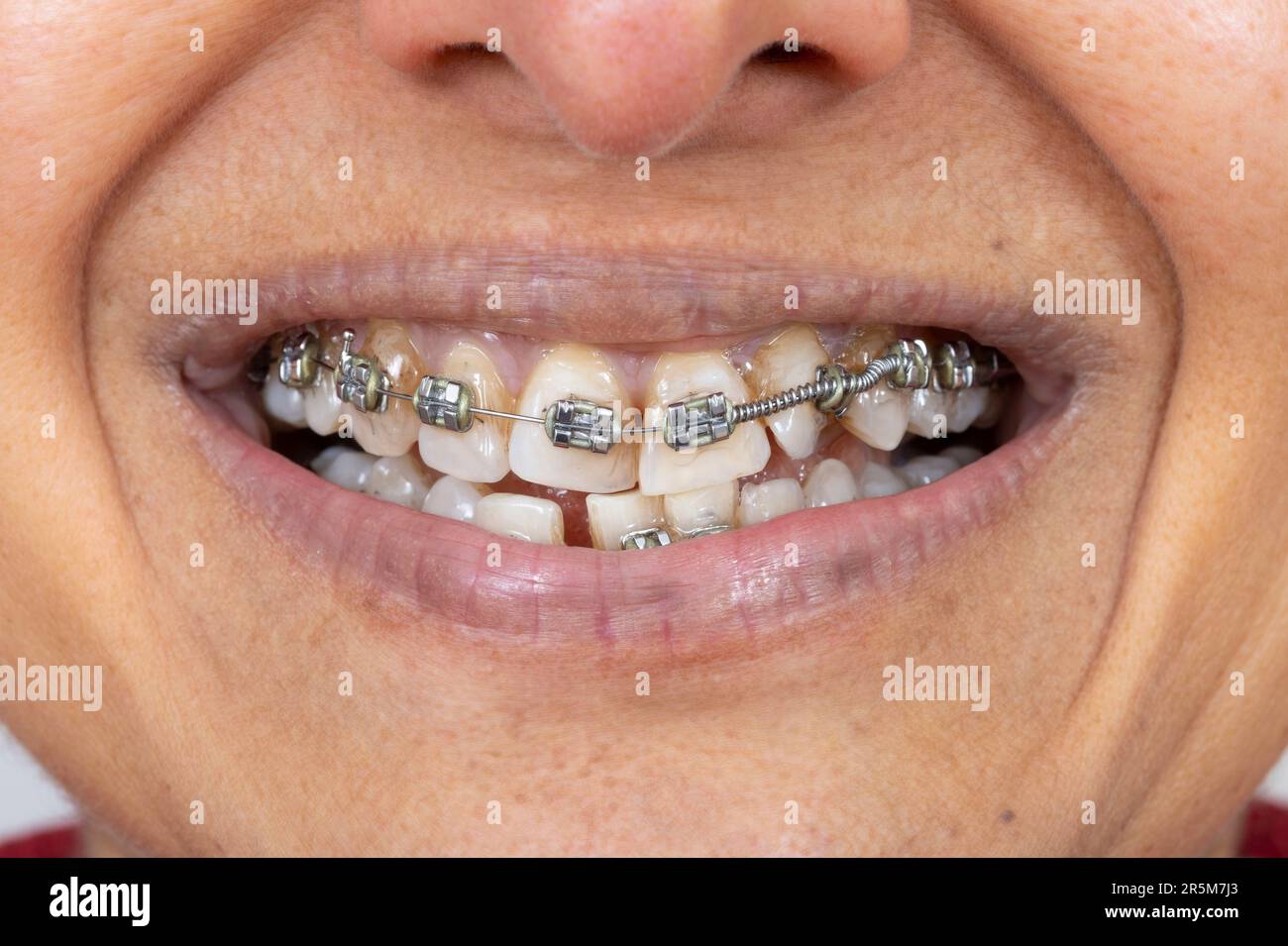 Metal braces on teeth of middle age Indian (British Asian) woman. Mouth