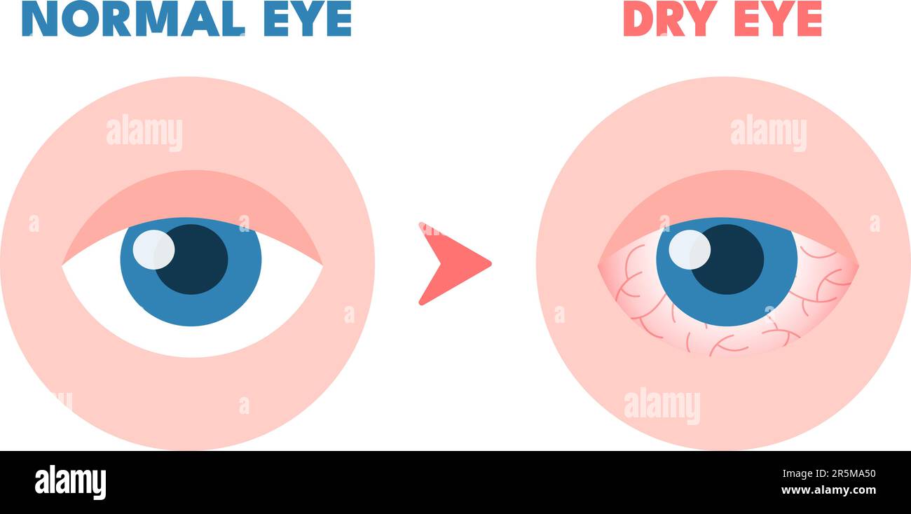 Dry eyes. Healthy unhealthy red eye, driing astonished redness