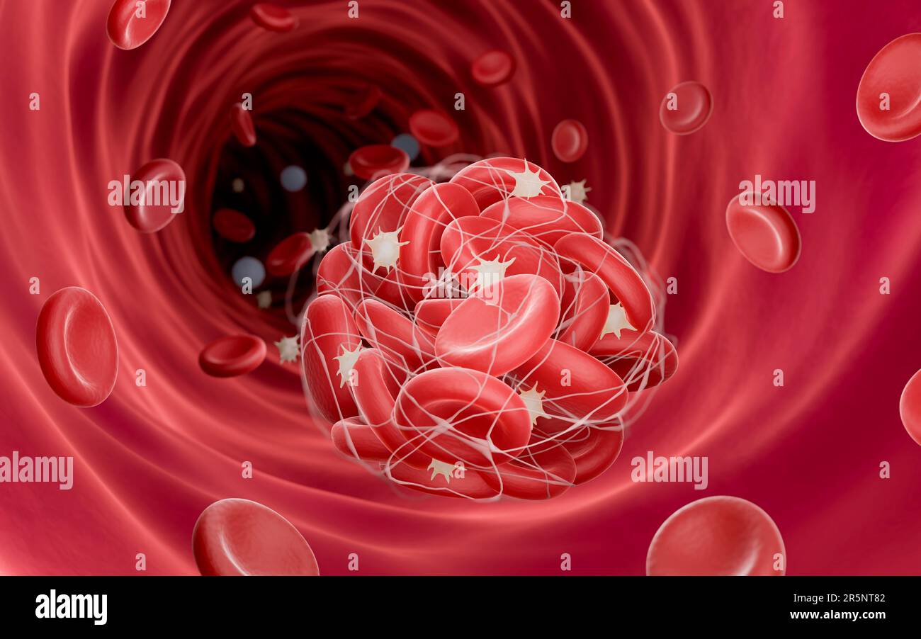 Blood Clot, Illustration Stock Photo - Alamy