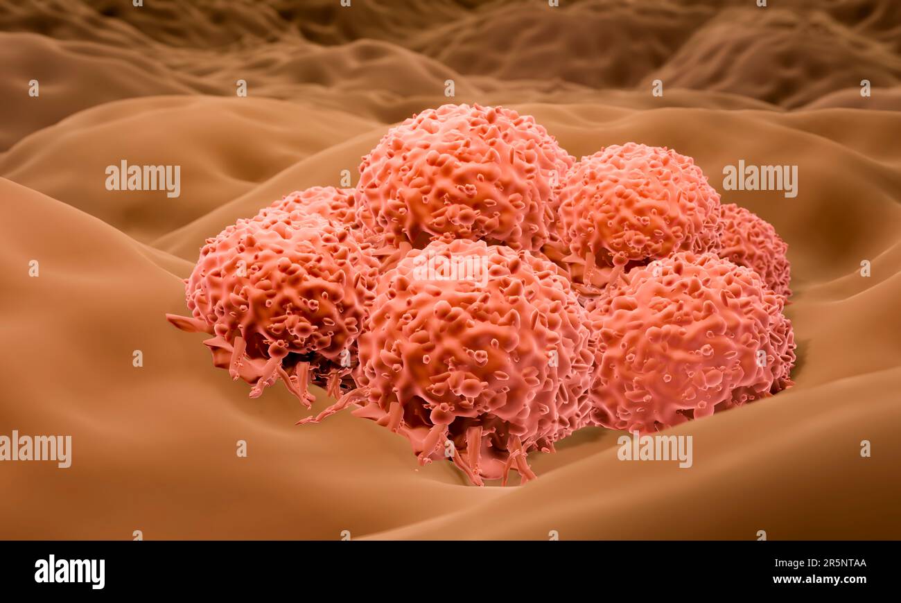 Melanoma cells, illustration Stock Photo Alamy