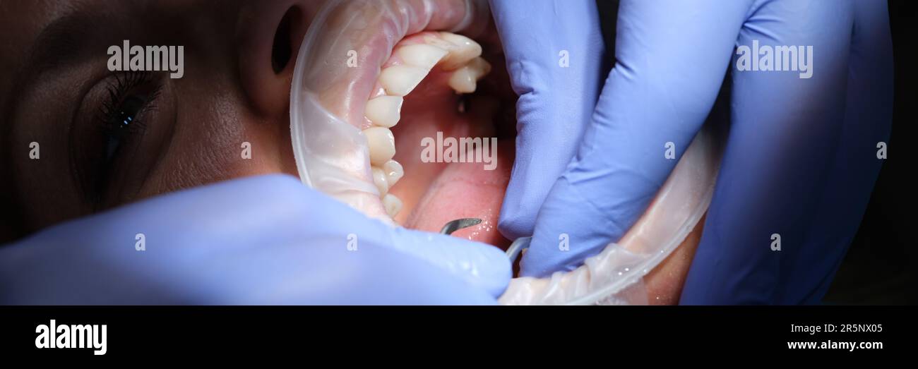 Dentist prepares female teeth for installation of ceramic veneers and