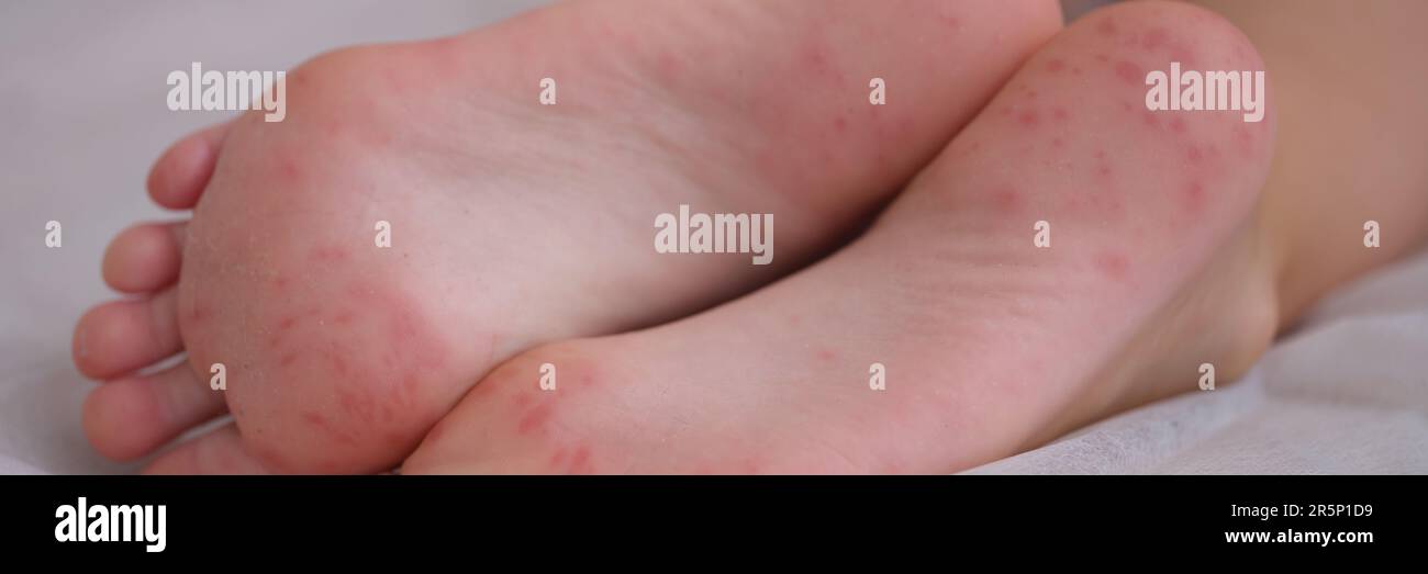 Eczema is an irritation caused by an allergic lesion of skin of feet in child Stock Photo