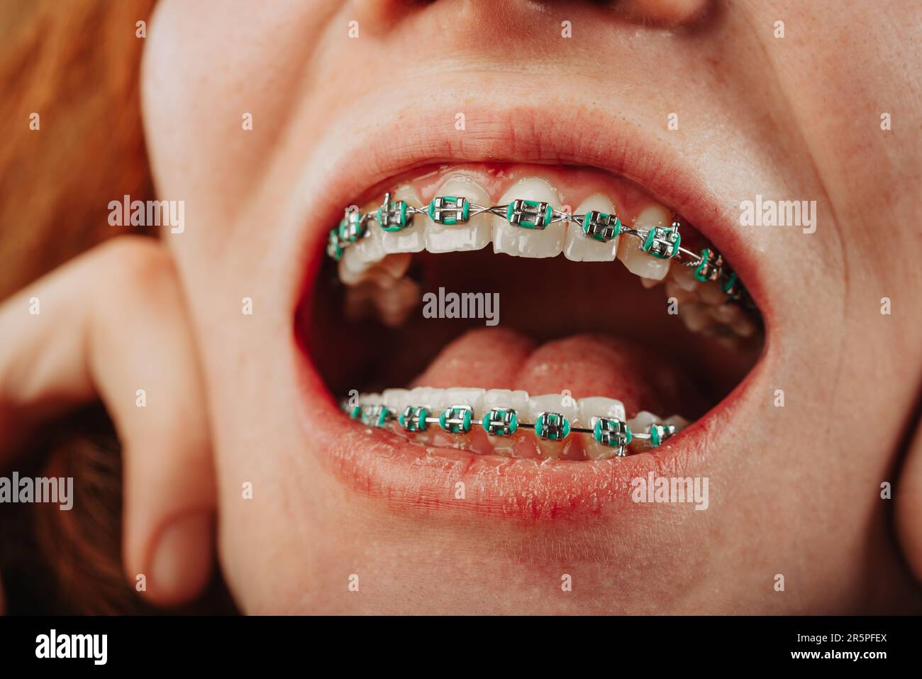 Close up of open girls mouth with teeth with braces on Stock Photo - Alamy