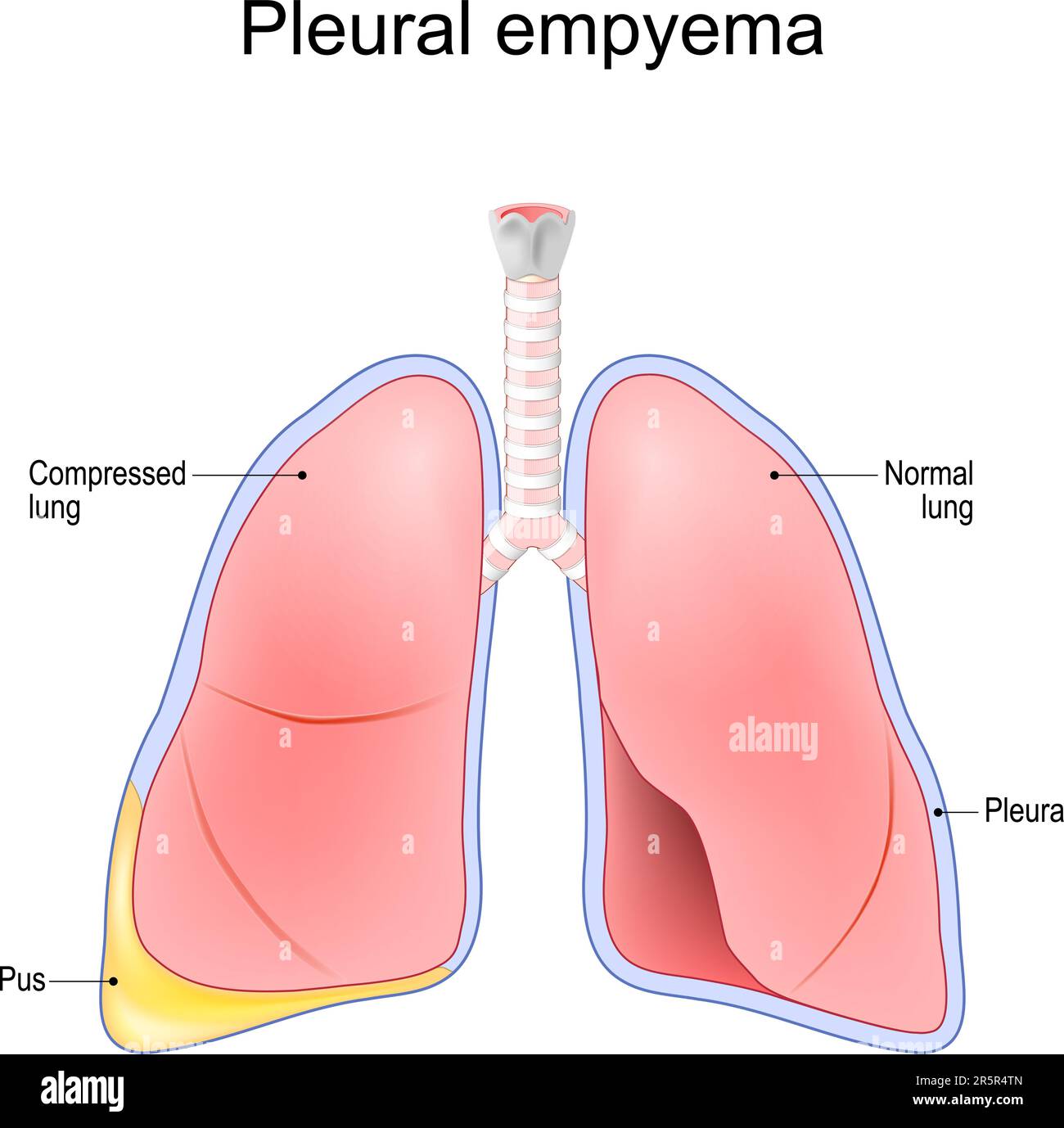 Pleural empyema. Normal lung and lungs after accumulation of pus within the pleural cavity. Vector illustration Stock Vector