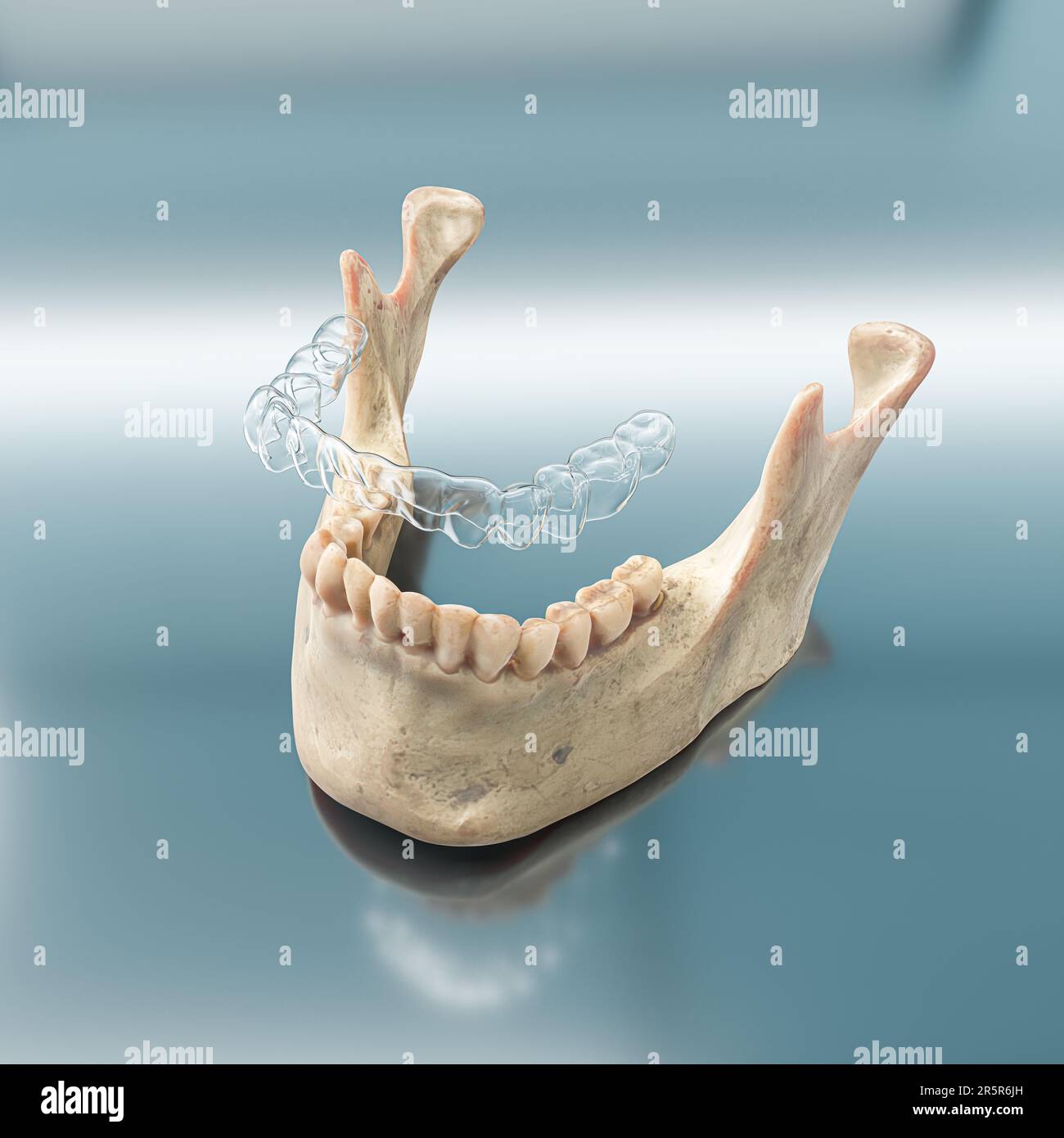 Transparent aligner orthodontic device above teeth cast. 3d
