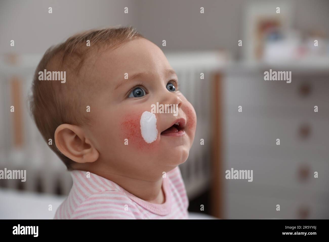 Cute little baby with antiallergic cream on her cheeks at home