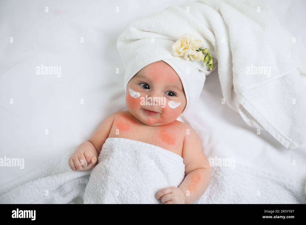 Cute little baby with antiallergic cream on cheeks, top view. Redness