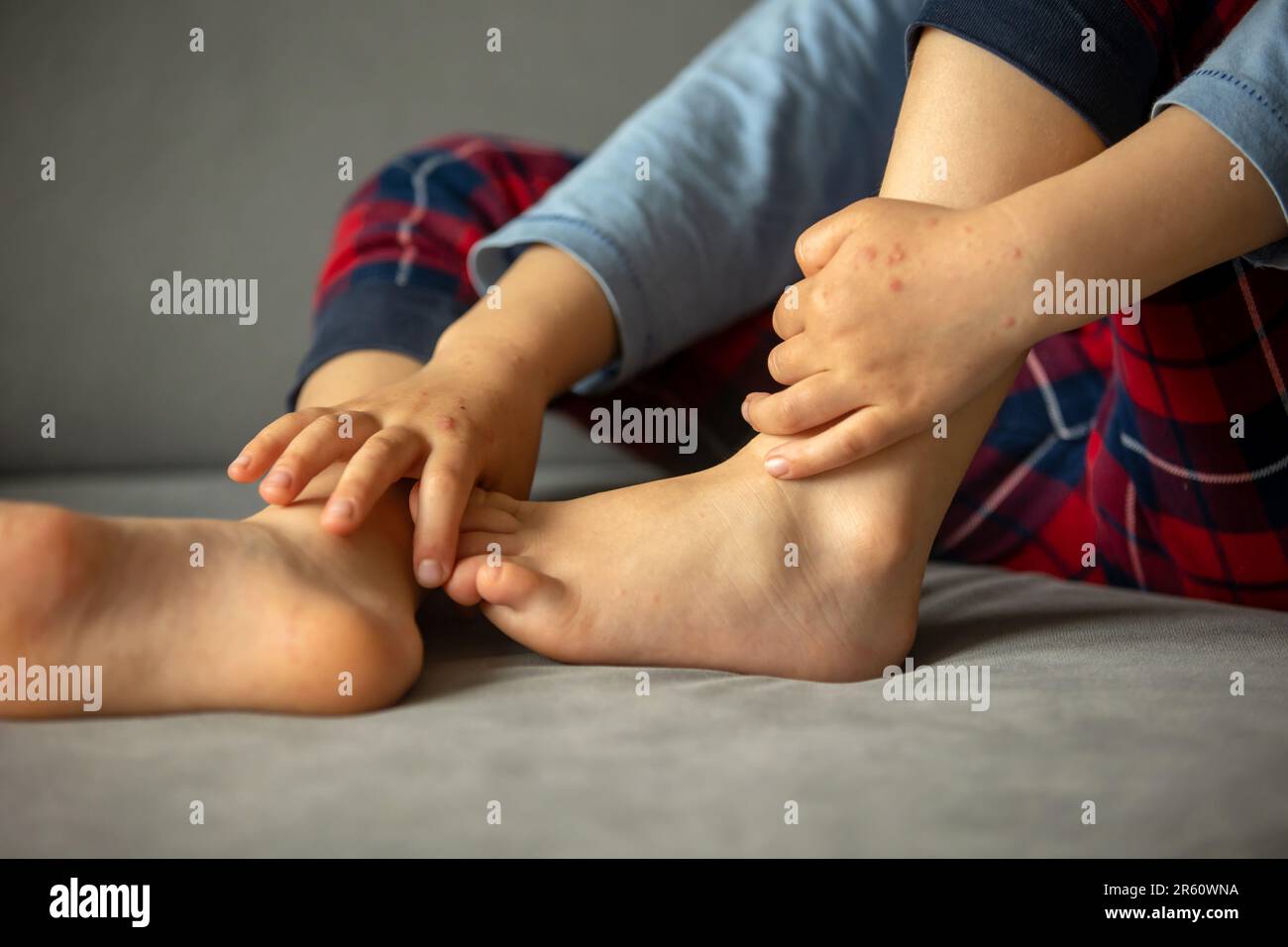 Child with skin rash, roseola, Hand-foot-and-mouth disease, child rash disease Stock Photo