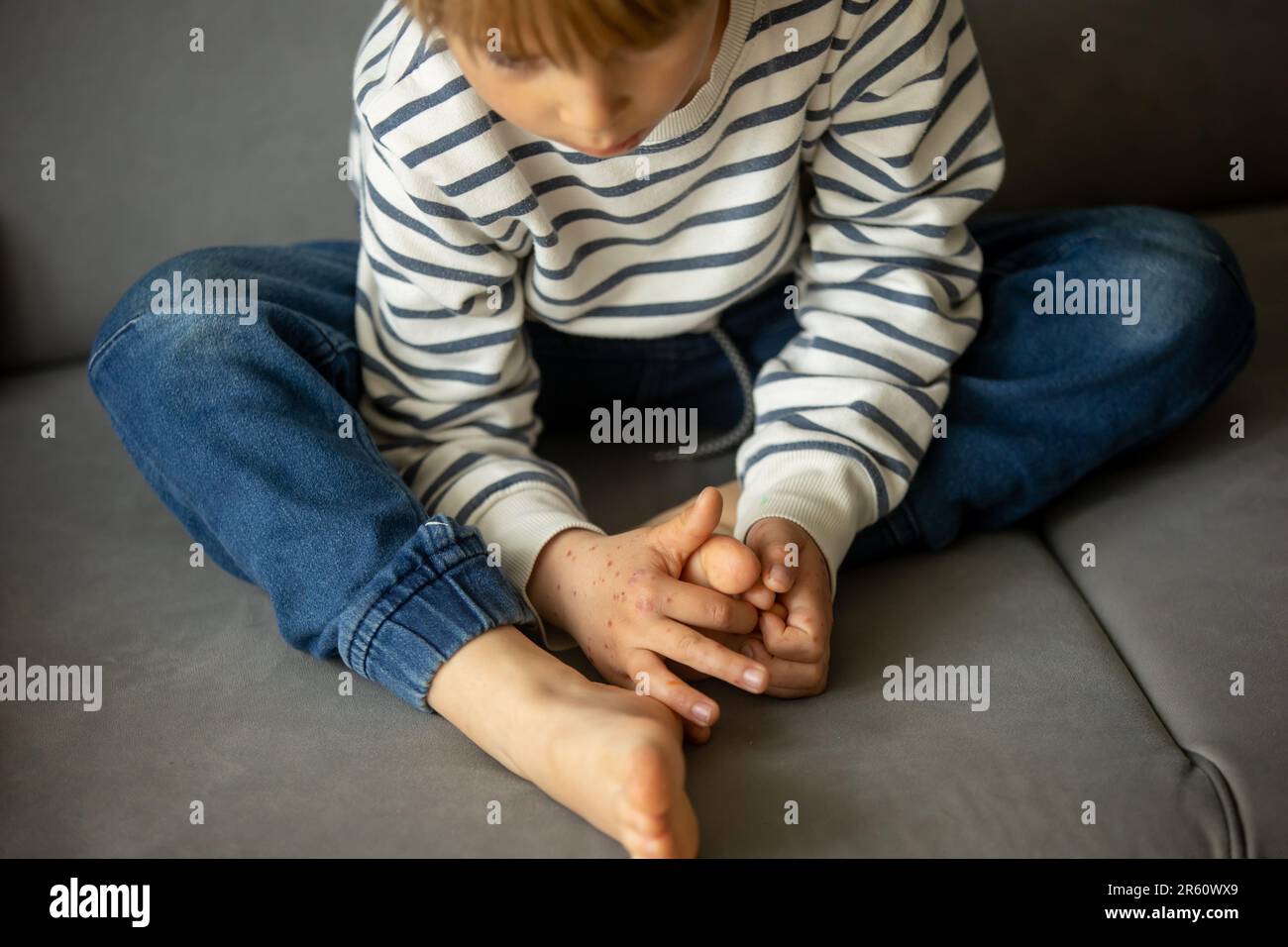 Child with skin rash, roseola, Handfootandmouth disease, child rash