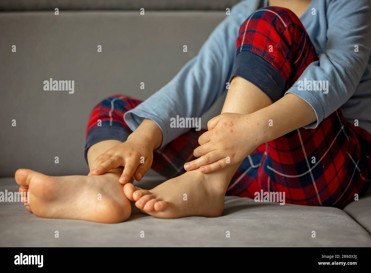 Child with skin rash, roseola, Handfootandmouth disease, child rash