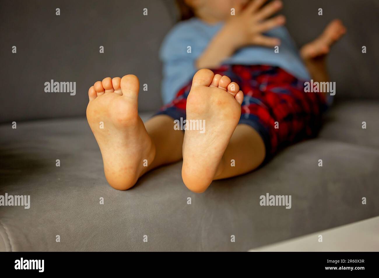 Child with skin rash, roseola, Handfootandmouth disease, child rash disease Stock Photo Alamy