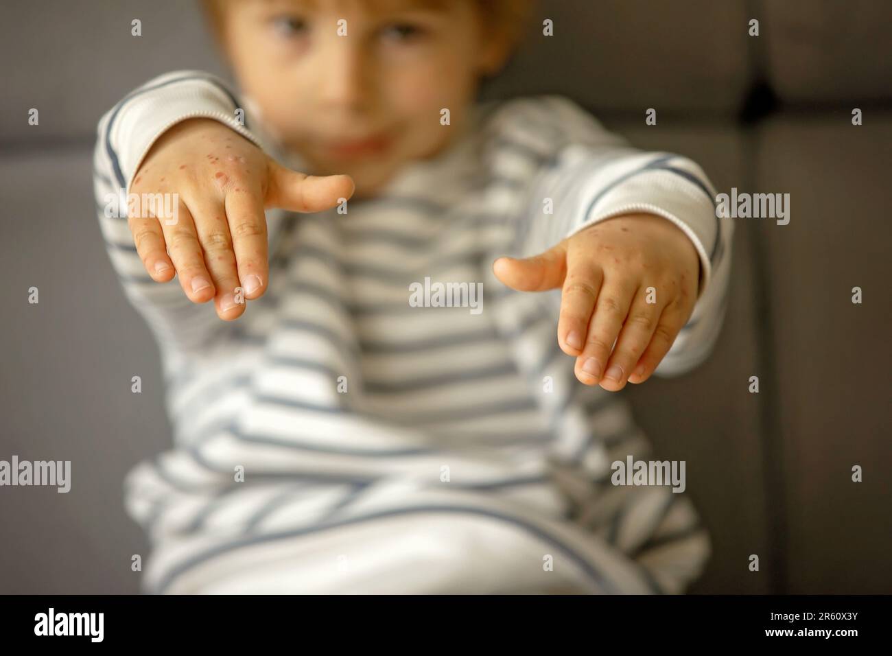 Child with skin rash, roseola, Hand-foot-and-mouth disease, child rash disease Stock Photo