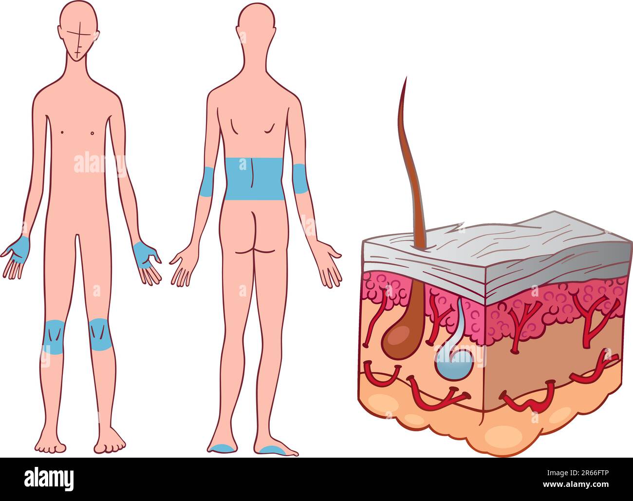 Illustration of psoriasis skin disease Stock Vector