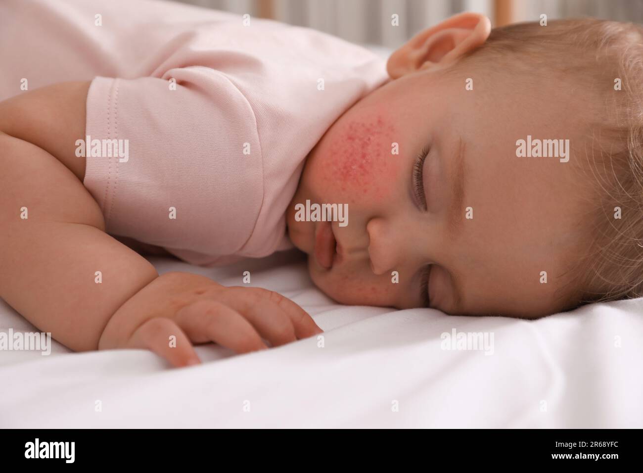 Cute little baby with allergic redness sleeping on bed, closeup Stock