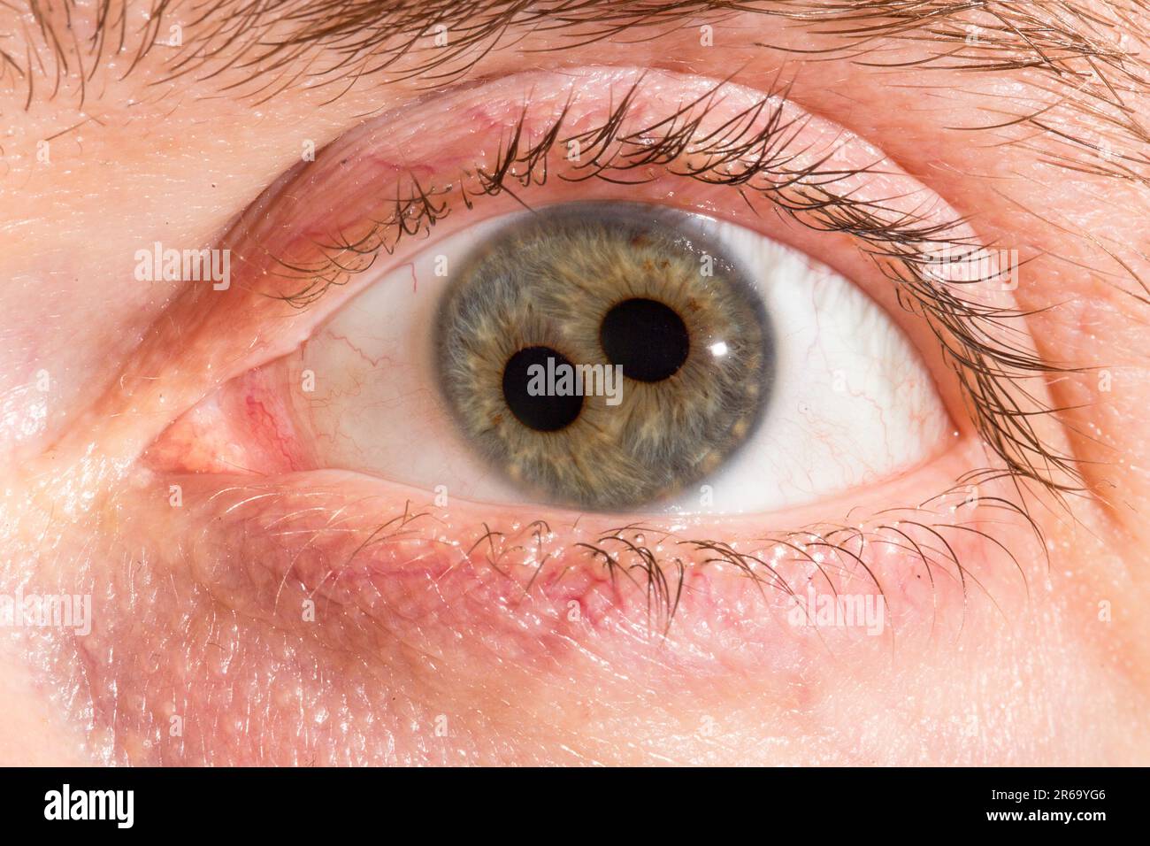 Macro of a man's human eye with double iris, close-up on the two pupils. Congenital eye disease called polycoria characterized by more than one pupill Stock Photo