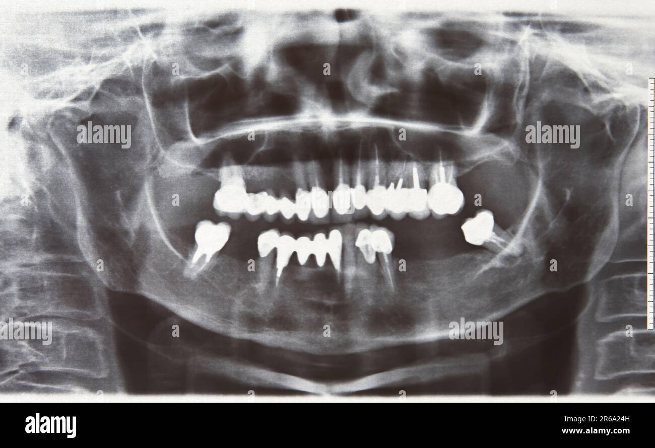 Panoramic Xrays of the oral cavity. Dentist treatment. Radiology Stock Photo Alamy