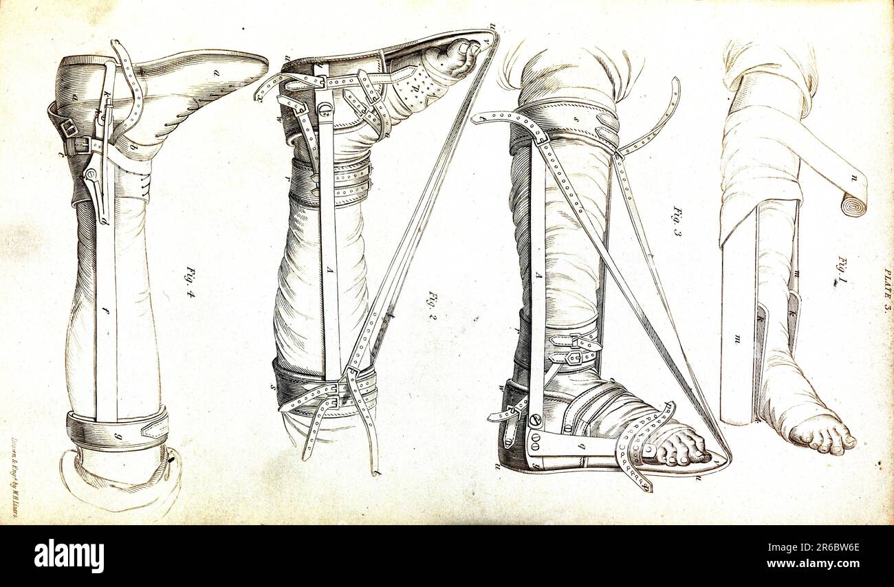Medicine, Anatomy, Surgery, Apparatus for correction of clubfoot after surgery, Post-operative, Leg, Bandage, c. 1820, Historic, digitally restored reproduction from a 19th-century original  /  Medizin, Anatomie, Chirurgie, Apparat zur Korrektur des Klumpfußes nach der Operation, Post-operativ, Bein, Bandage, um 1820, Historisch, digital restaurierte Reproduktion von einer Vorlage aus dem 19. Jahrhundert Stock Photo