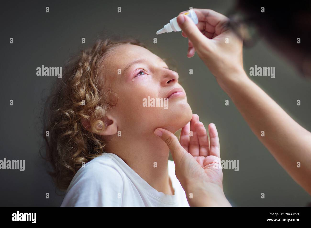 Child with swollen pink eye. Eyes infection and pollen allergy
