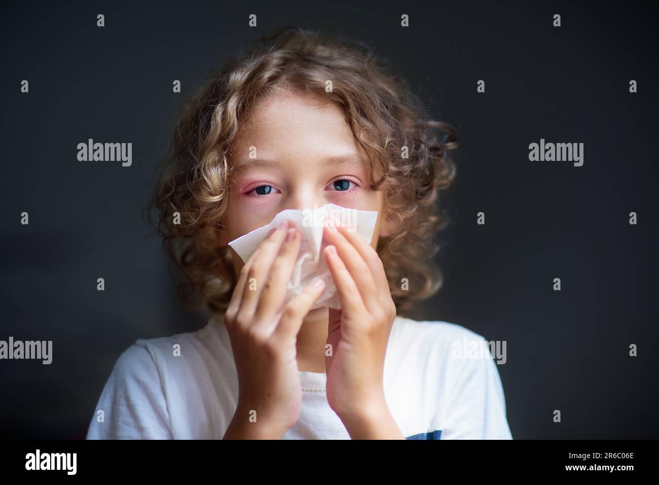 Child with swollen pink eye. Eyes infection and pollen allergy
