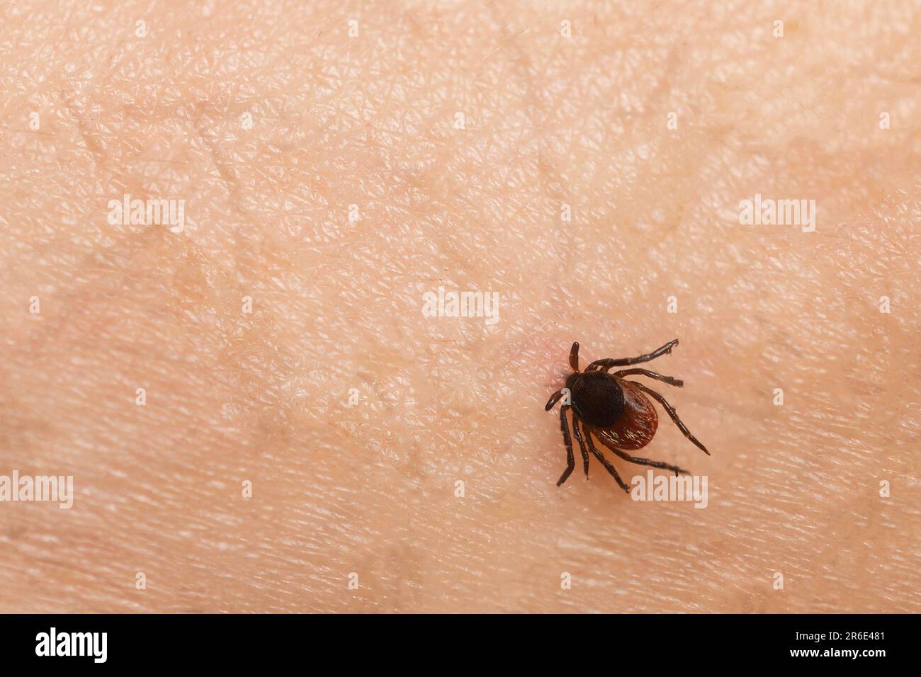 Tick bite on a person's skin Stock Photo