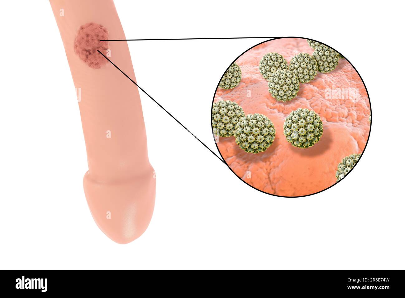 Understanding and Treating Warts - Hudson Dermatology, image size:1300x956