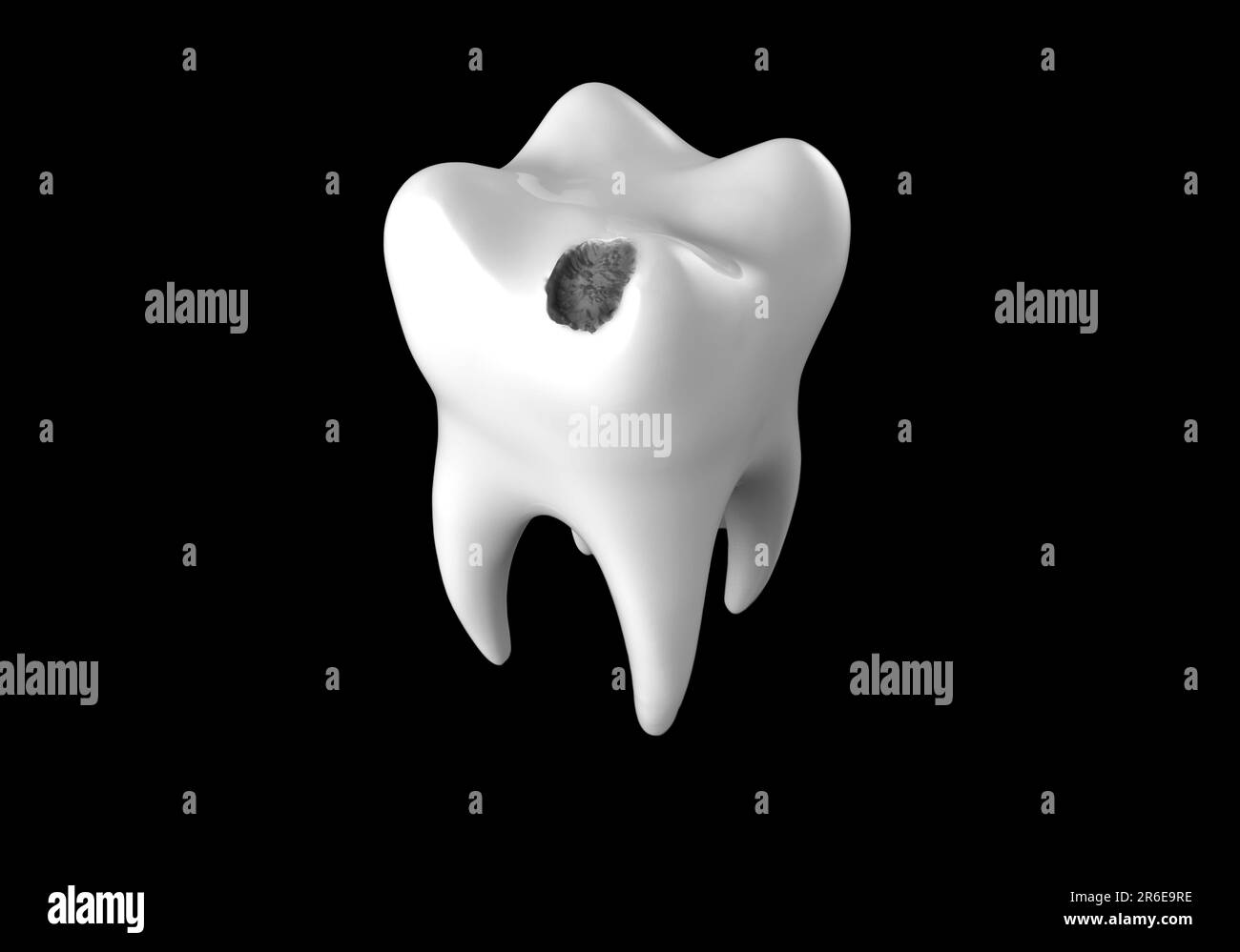 Tooth decay. Computer artwork of a tooth with cavity Stock Photo Alamy