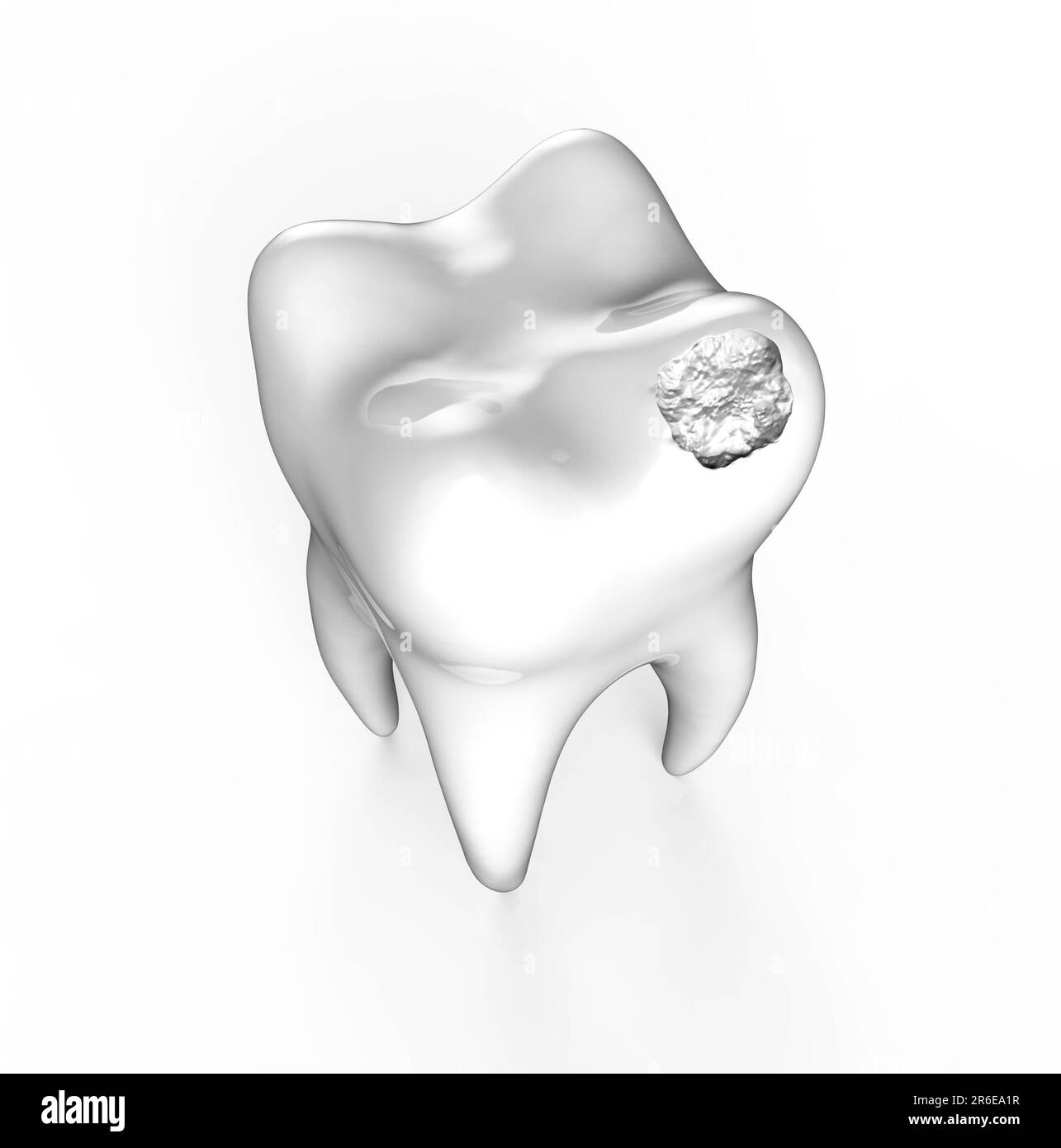 Tooth decay. Computer artwork of a tooth with cavity Stock Photo Alamy