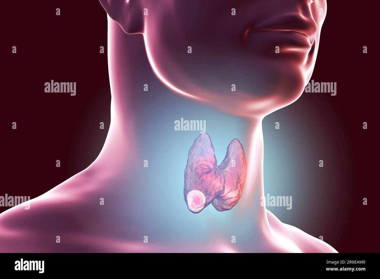 Tumor in human thyroid gland, computer illustration Stock Photo - Alamy