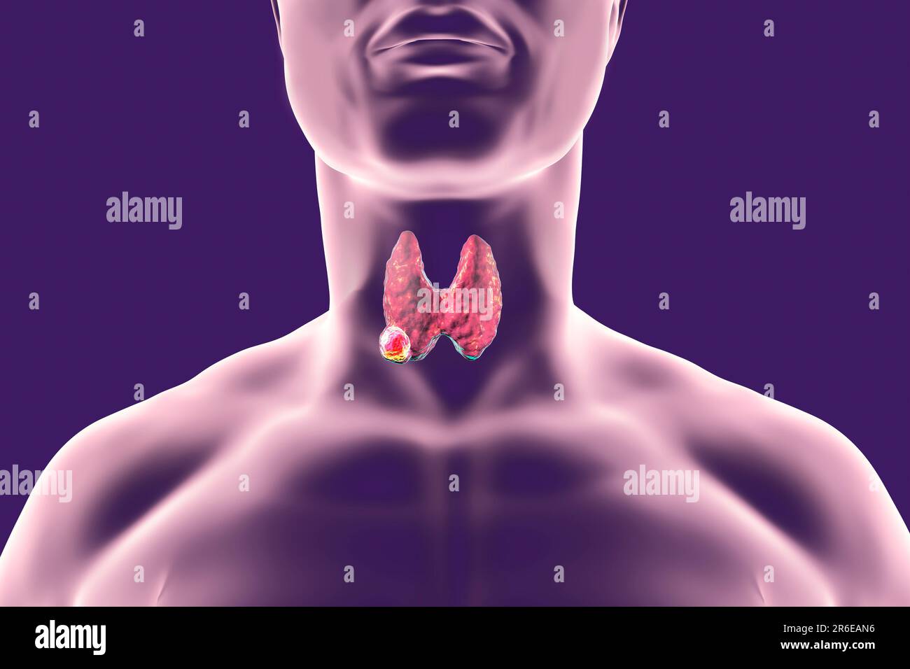 Tumor in human thyroid gland, computer illustration Stock Photo - Alamy