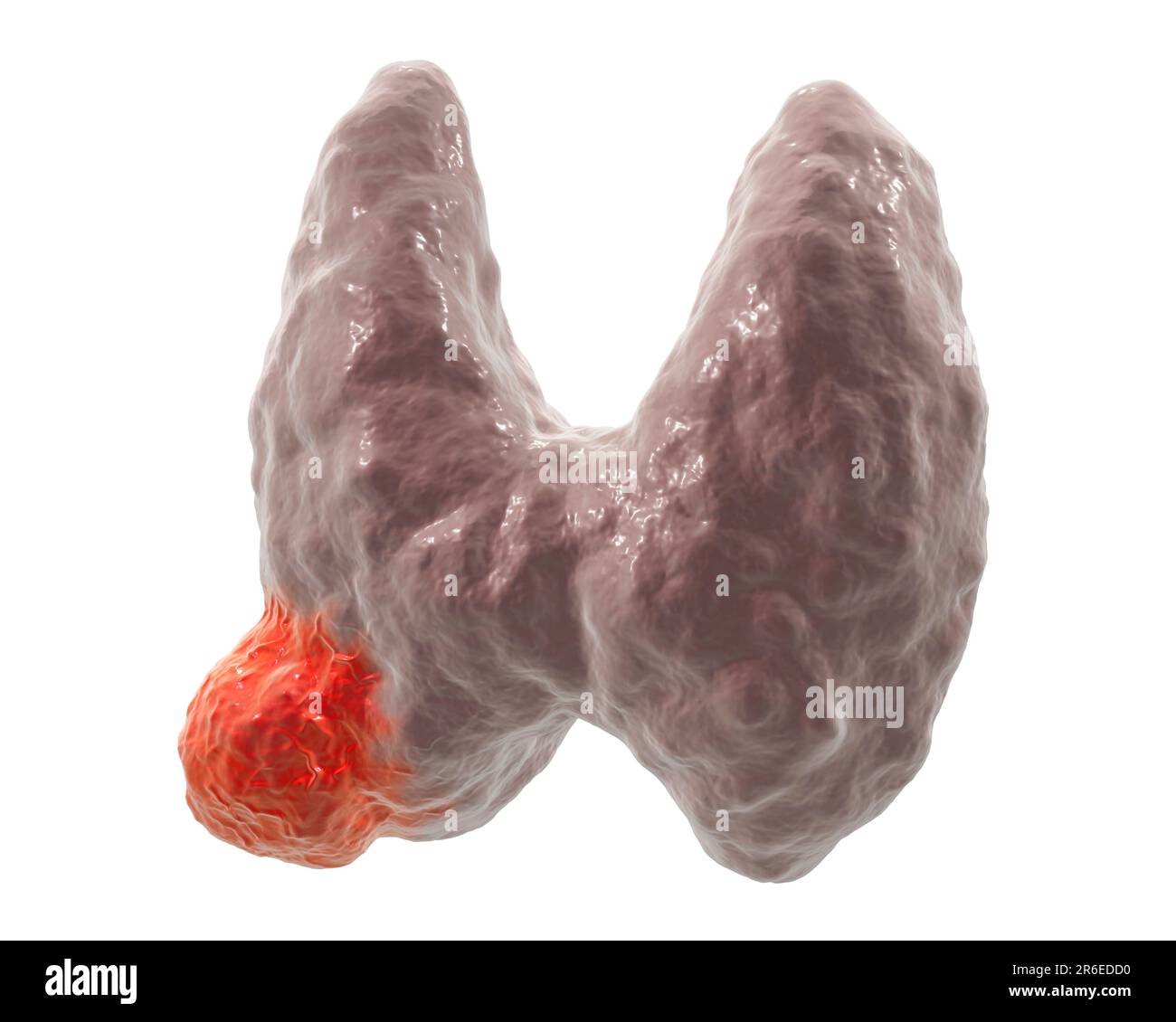 Tumor in human thyroid gland, computer illustration Stock Photo - Alamy