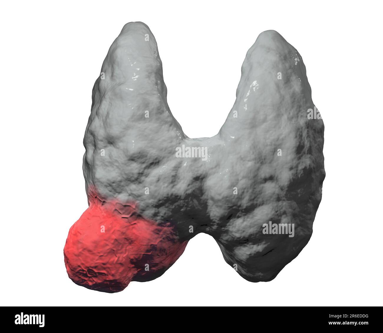 Tumor in human thyroid gland, computer illustration Stock Photo - Alamy