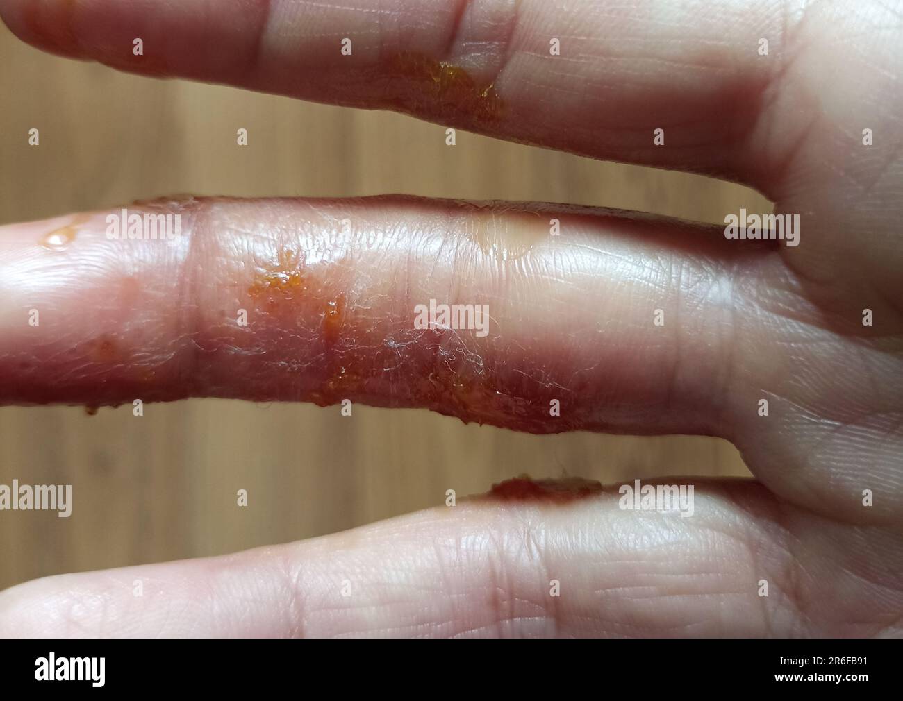 Sudden Rash On Hand rash eczema dermatitis on hand. inflammation of skin Stock Photo - Alamy
