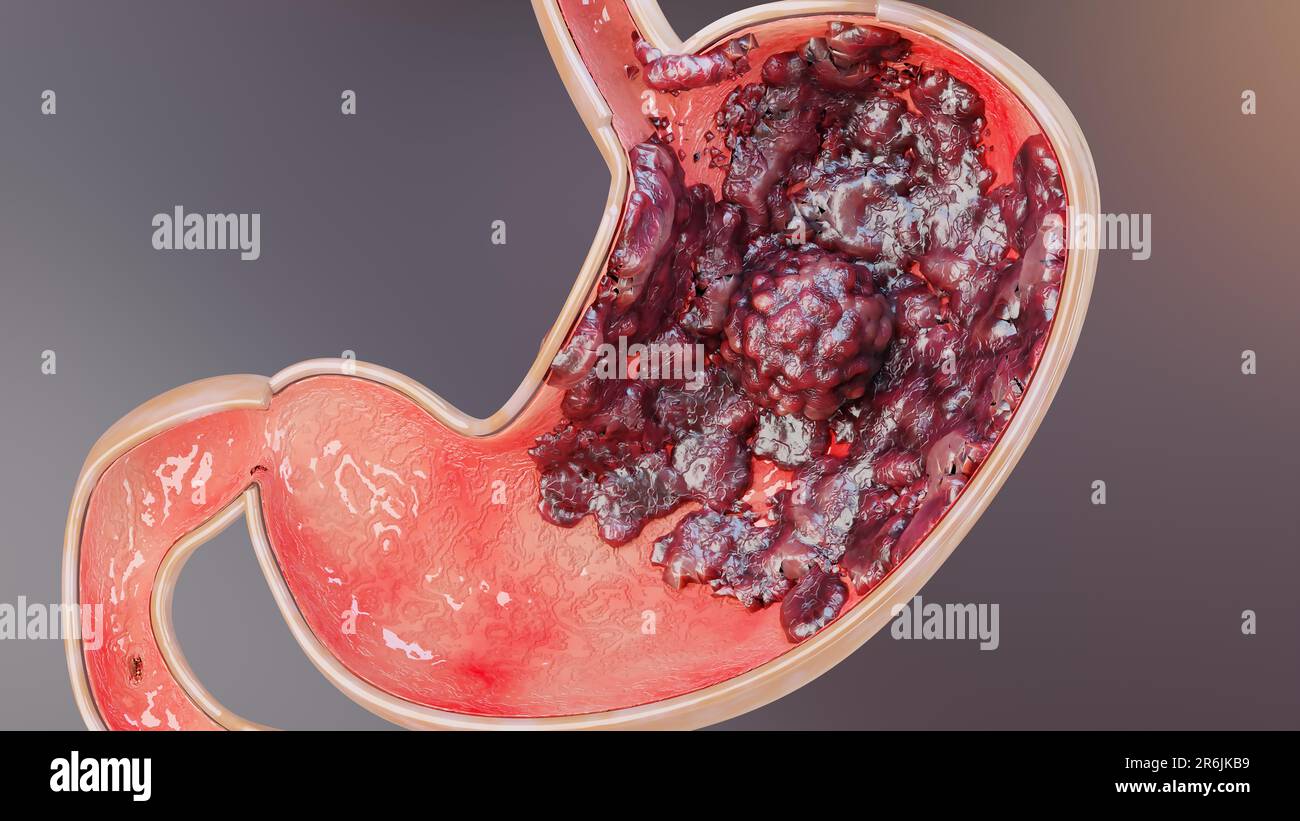 Early Stage Stomach Cancer Symptoms early-stage-stomach-cancer-symptoms